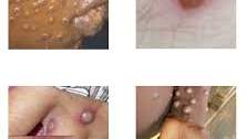 Nigeria reports 39 confirmed Monkey pox cases across several states including the FCT