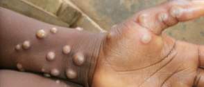 Mpox: Africa CDC writes African health ministers as cases hit 21,466