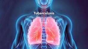 Lagos raises alarm over 14,000 undiagnosed TB cases