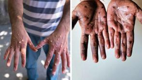 New strain of monkey pox detected in Thailand