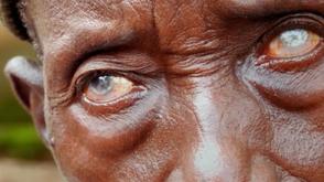 Plateau records 2.7% blindness prevalence –Commissioner