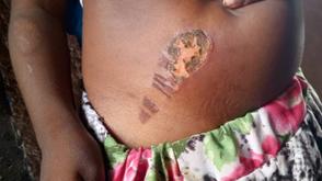Stepmother allegedly brutalises 5-year-old girl for bed wetting in Bauchi