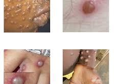 WHO says Europe can defeat monkey pox, must help Africa obtain vaccines