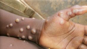 Mpox: The new adversary