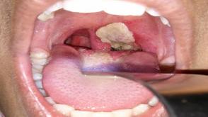 Diphtheria outbreak in Edo claims two lives outbreak