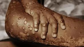 Mpox: Africa records over 61,000 cases as treatment research gains momentum