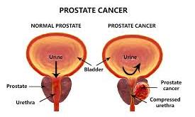 Frequent ejaculation may lower prostate cancer risk, Expert says