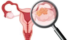 Ovarian Cancer: Why Nigerian women are dying in silence