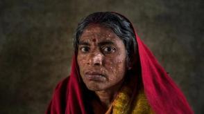 WHO unveils safer, shorter treatment guidelines for Visceral Leishmaniasis