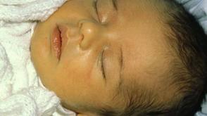 Paediatrician urges early hospital assessment for neonatal jaundice