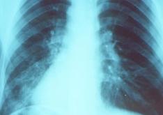 Mistaking pneumonia for cold can delay lifesaving treatment- Expert