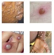 Resident doctors caution against eating undercooked bush meat due to M-pox concerns