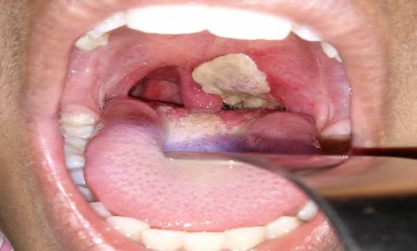 Diphtheria outbreak in Edo claims two lives outbreak