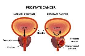 Frequent ejaculation may lower prostate cancer risk, Expert says