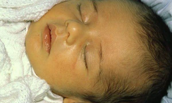 Paediatrician urges early hospital assessment for neonatal jaundice