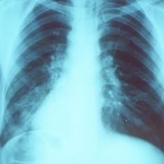 Mistaking pneumonia for cold can delay lifesaving treatment- Expert