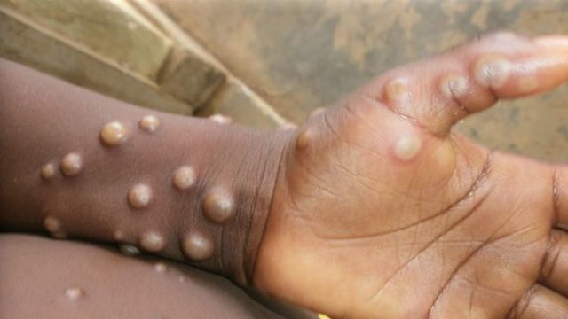 Nigeria records 54 new suspected MPox cases