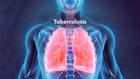 Lagos raises alarm over 14,000 undiagnosed TB cases