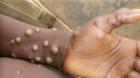From Lassa fever to Cholera, now Mpox: Where did we get it wrong?